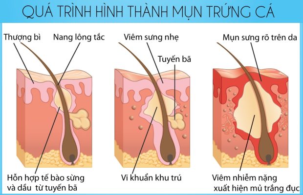 Mụn Trứng Cá gây Tăng tiết bã nhờn