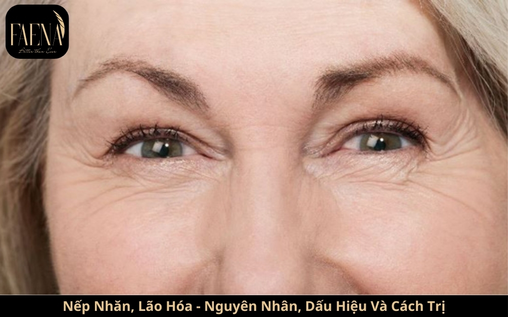 Nếp Nhăn, Lão Hóa - Nguyên Nhân, Dấu Hiệu Và Cách Trị